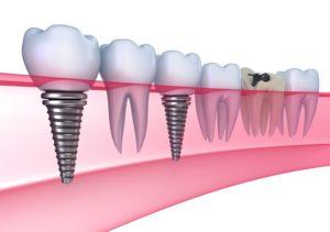 Dental Crown Functionality